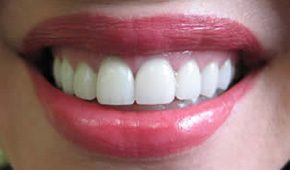 Closeup of beautiful white smile after
