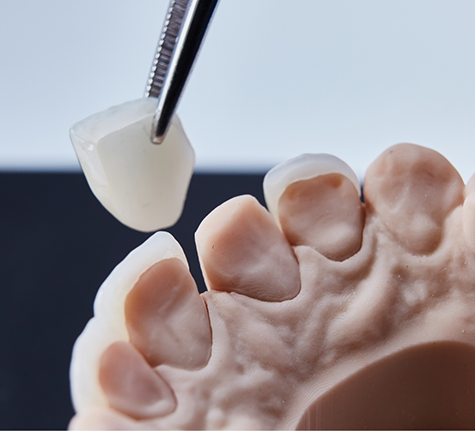 Cosmetic dentist placing a veneer over a model of a tooth