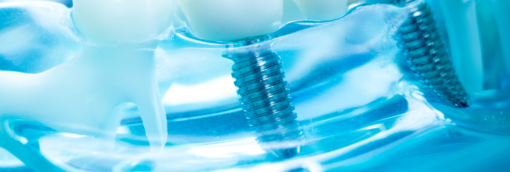 Model of the mouth with two dental implants in Winthrop