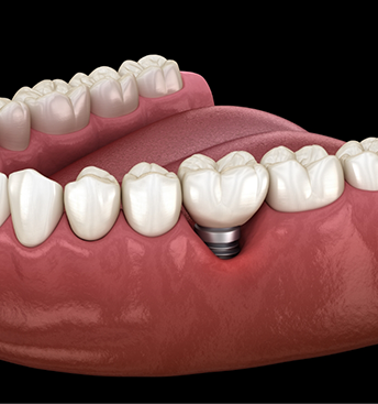Illustrated dental implant and crown replacing one missing tooth