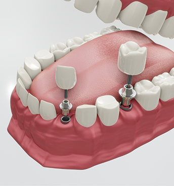Illustration of two dental implants with crowns replacing two teeth