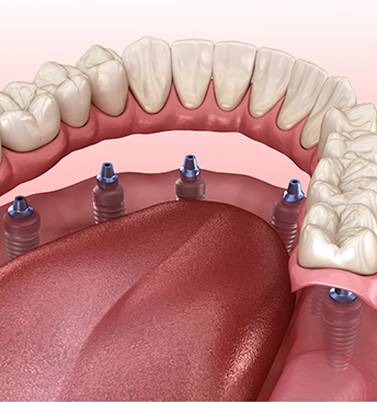 Illustration of six dental implants supporting a full denture