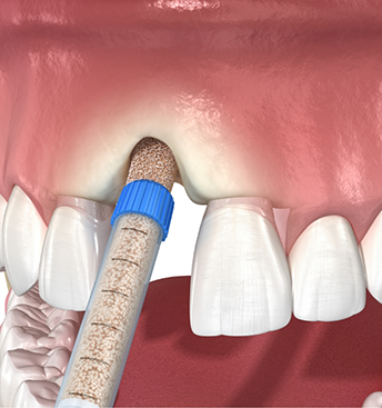 Illustration of bone grafting material being placed in the jawbone after a tooth extraction
