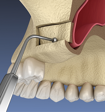Illustration of the sinus membrane being gently shifted