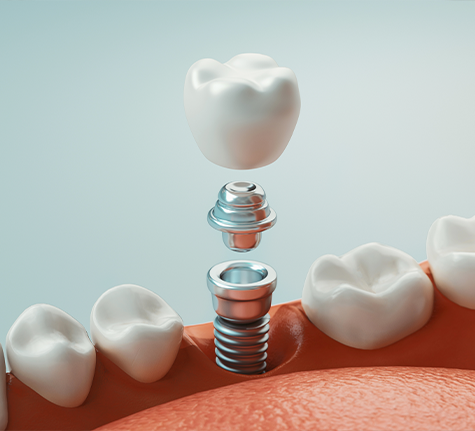 Illustration of a dental implant being placed into the lower jaw