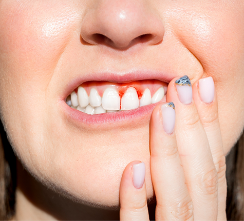 Close up of a person with red gums before gum disease treatment in Winthrop
