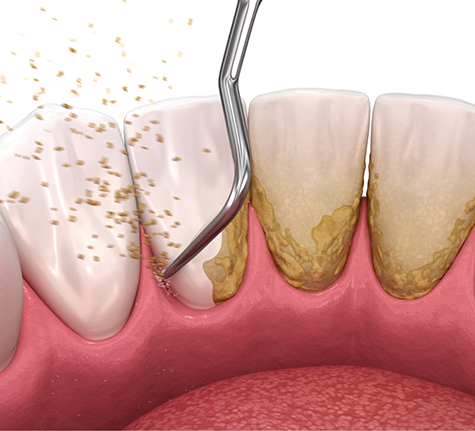 Illustration of a dental scaler removing tartar from the gumline