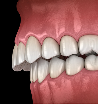 Illustration of an overbite