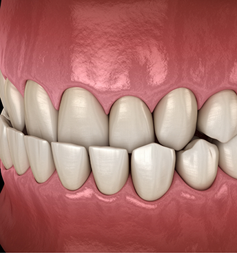 Illustration of an underbite