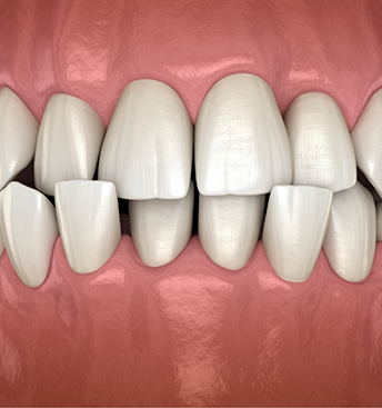Illustration of a closed jaw with overlapping upper and lower teeth