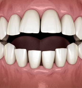 Illustration of a closed jaw with the teeth open in the middle