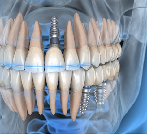 Illustrated x ray of a person with dental implants replacing their missing teeth