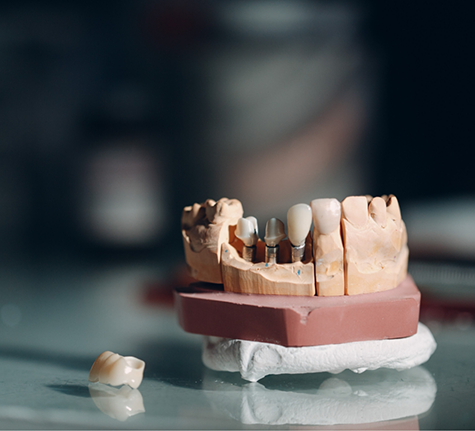 Model of the mouth with mini dental implants replacing missing teeth