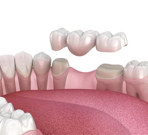 Illustration of a dental bridge replacing a missing tooth