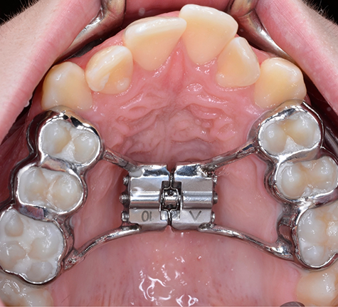 Close up of a mouth with a palatal expander and braces