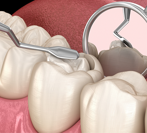 Illustration of a part of a tooth being removed