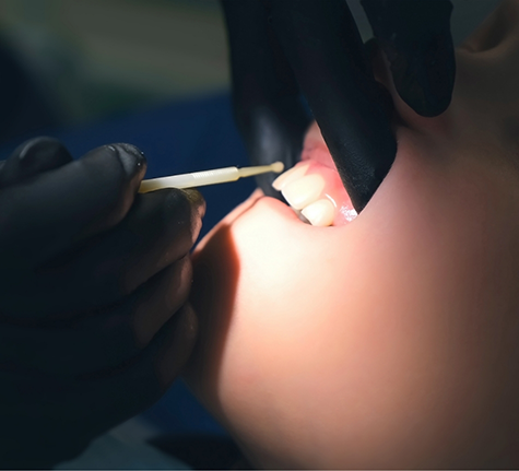 Dental patient having fluoride applied to their teeth
