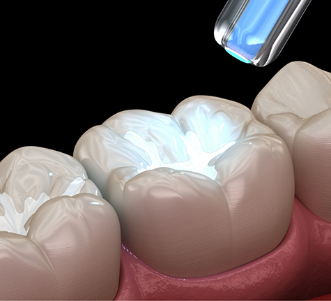Illustration of a sealant being placed on a tooth