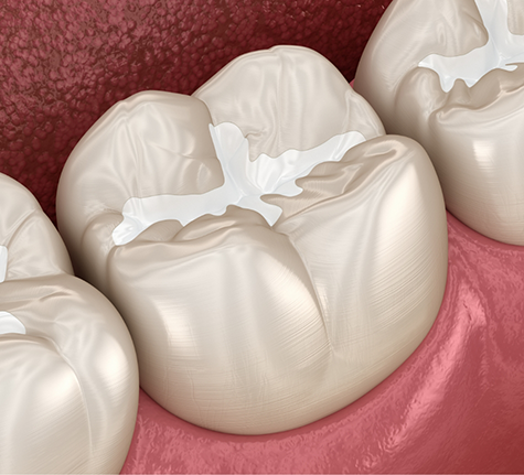 Illustrated tooth with a white filling