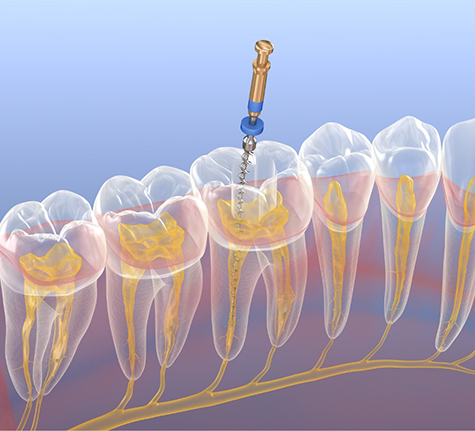 Illustration of a thin dental instrument performing root canal treatment on a tooth