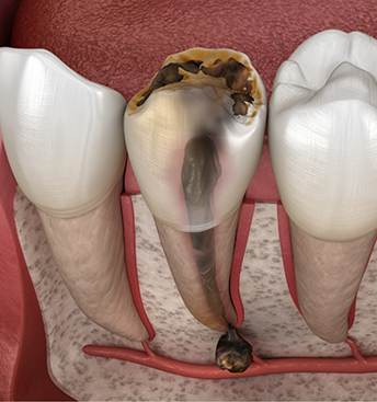 Illustration of a severely damaged tooth