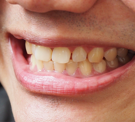Close up of a smile with yellowed teeth before teeth whitening in Winthrop