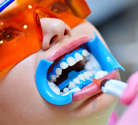 Woman getting professional teeth whitening at the dentist