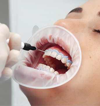 Dental patient having whitening solution applied to their teeth