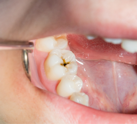 Close up of a tooth with a sizeable cavity