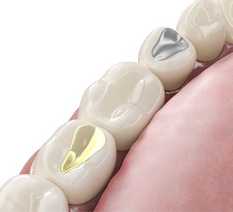 Illustration of a tooth colored filling between two metal fillings