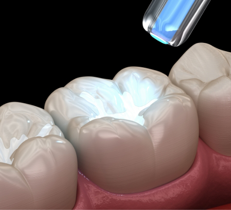 Illustration of a tooth colored filling being hardened with an ultraviolet light