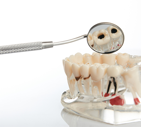 Model of the teeth with a few damaged teeth requiring tooth extractions