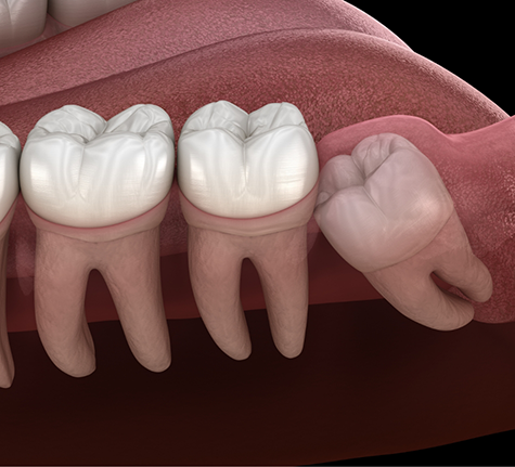 Illustration of an impacted wisdom tooth pressing against the adjacent tooth