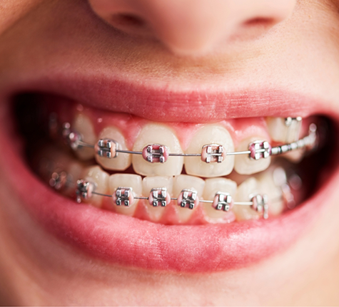 Close up of a smile with traditional braces in Winthrop