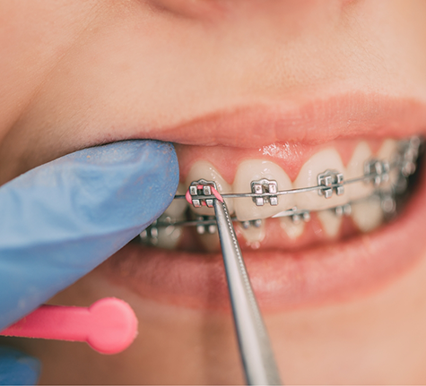 Orthodontist placing elastic bands on a patient's braces