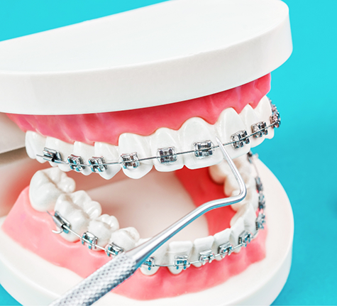 Model of the teeth with braces