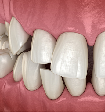 Illustration of a mouth with crooked teeth