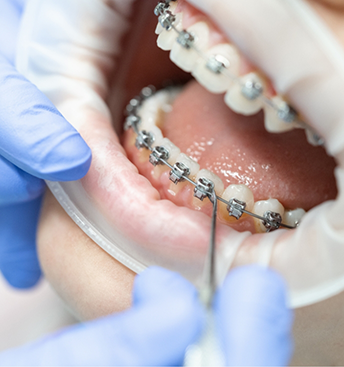 Person with braces getting a dental exam