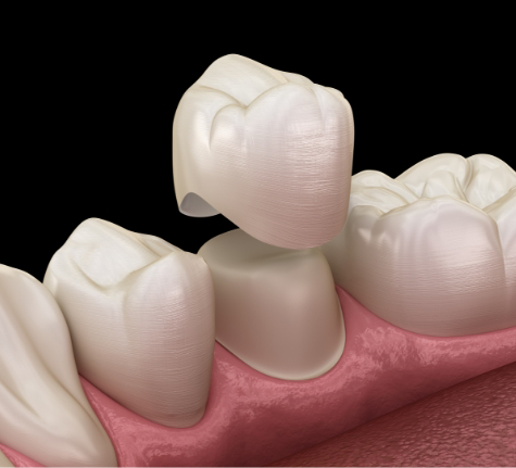 Illustration of a dental crown in Winthrop being fitted over a tooth