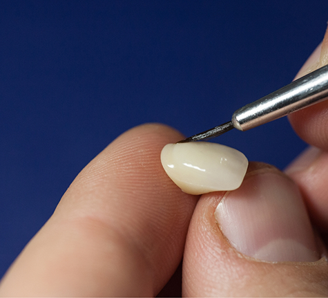 Dentist placing adhesive material on a veneer