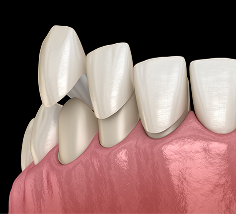 Illustration of veneers being placed over the front teeth